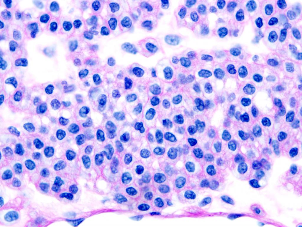 Tuli’s tumor, stained with a special staining technique called “Periodic Acid – Schiff” or “PAS.” The fine, pink-staining membranes surrounding individual cells are a key feature in the diagnosis of a glomus tumor.