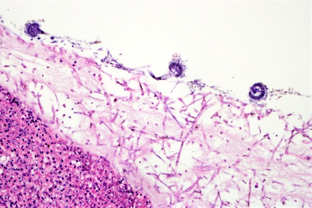 Figure 2: Microscopic view of fungal hyphae with 3 fruiting bodies colonizing an airway in a duck.