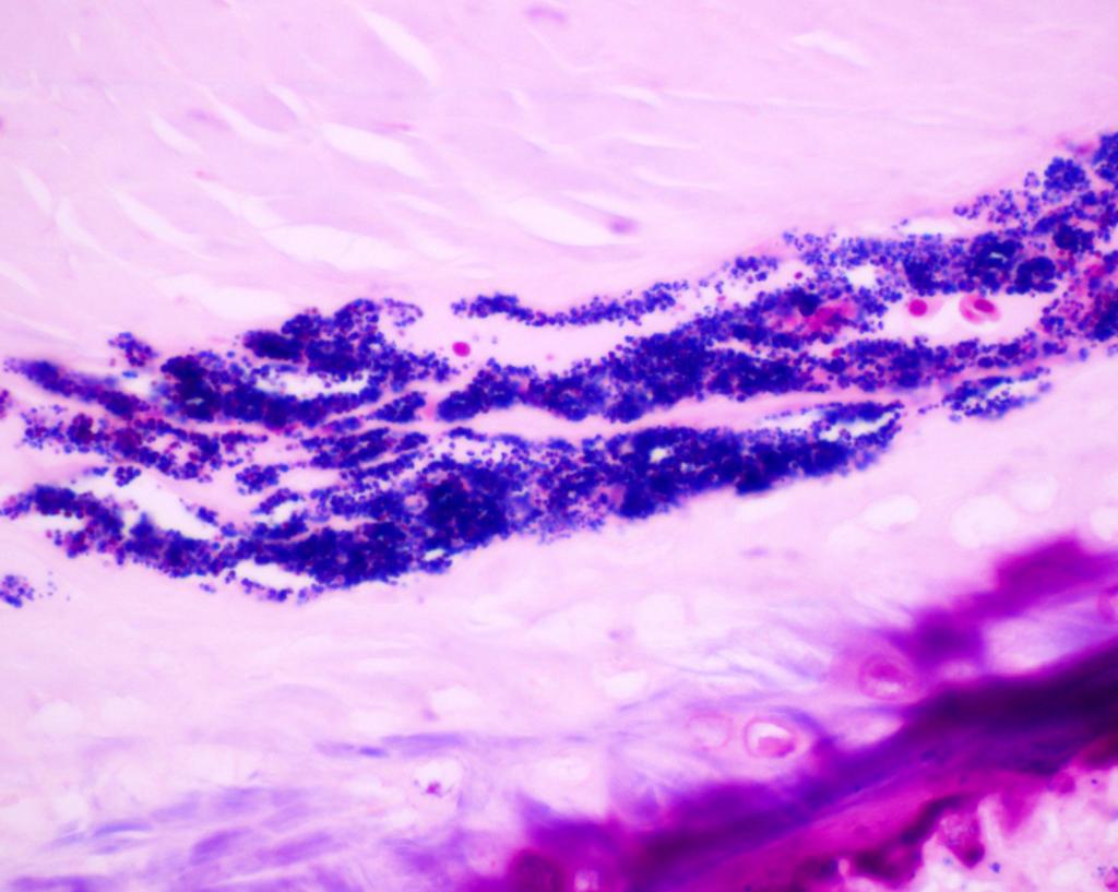 An aggregate of Gram-positive cocci in skin from a smew. This duck had a wing injury that had become infected with Staphylococcus.