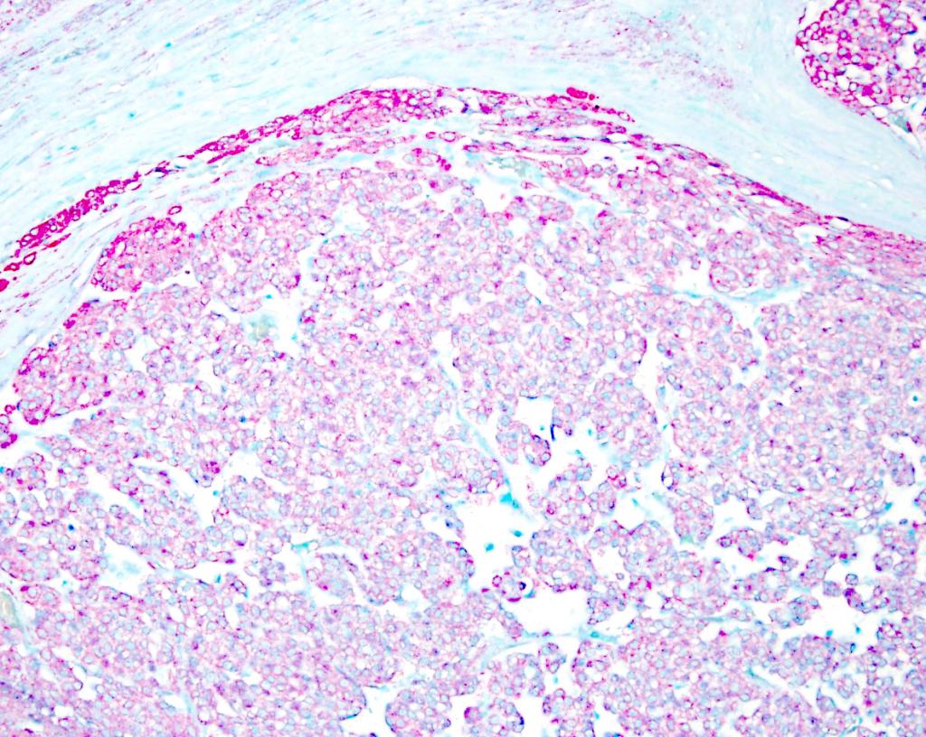 Immunohistochemistry helped us arrive at the final diagnosis. Here, the pink staining is positive “immunoreactivity,” indicating the presence of a type of protein found only in certain types of muscle cells.