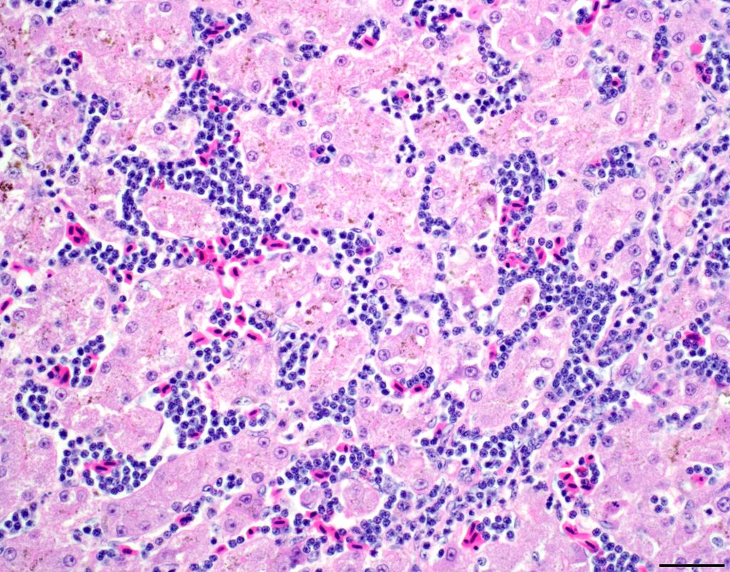 Liver (pink) with capillaries filled with more neoplastic lymphocytes (purple) than red blood cells (bright pink-red).