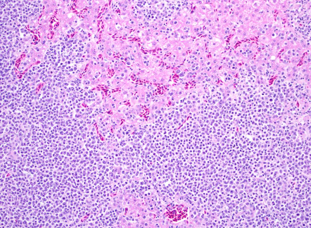 Photomicrograph of liver (pink) with an infiltrate of neoplastic lymphocytes (purple) disrupting the tissue.