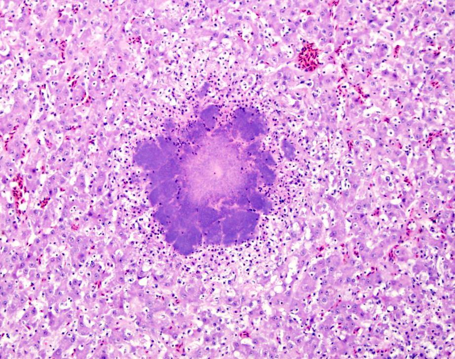 Histologic image of liver from the crow showing the whitish spots are large colonies of bacteria (purple) identified by bacterial culture as Y. pseudotuberculosis.