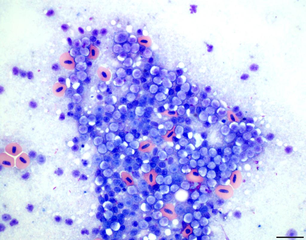 Impression smear of liver from the duck showing predominantly neoplastic lymphocytes mixed with a few normal red blood cells.