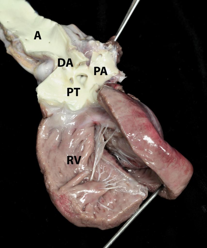On the right side, notice how much bigger the opened right ventricle (RV) is compared to the LV. It is abnormally dilated, and its outflow tract can be followed into the pulmonic trunk (PT), which leads into the pulmonary arteries (PA) as well as a large connection (DA) to the aorta (A).
