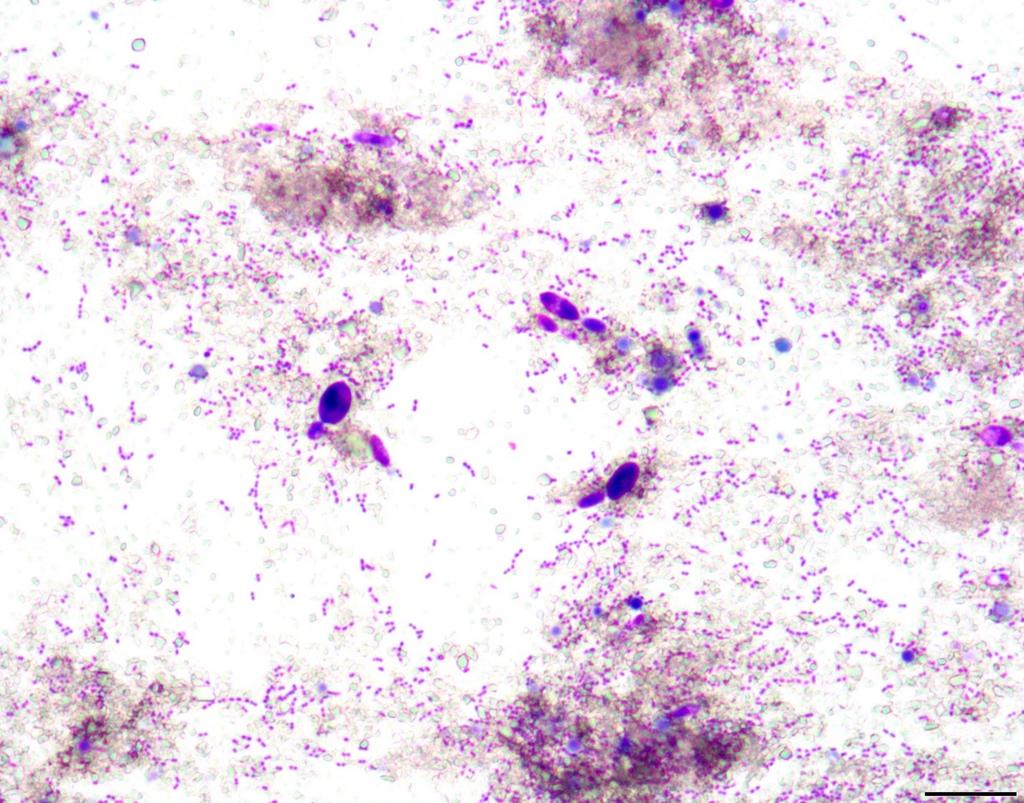 Cytologic preparation of tarantula vomit examined under a microscope. The large oval purple structures appear to be yeasts (fungus), while the numerous small purple structures arranged in chains are bacteria.